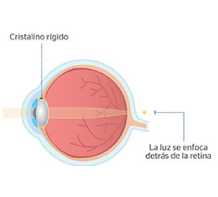 ojo con presbicia